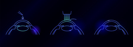 LASIK eye surgeryのイラスト素材