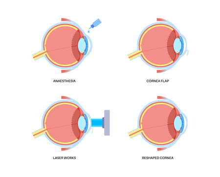 LASIK eye surgeryのイラスト素材