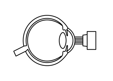 LASIK eye surgeryのイラスト素材