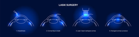 LASIK eye surgeryのイラスト素材
