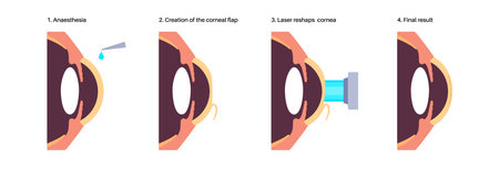 LASIK eye surgeryのイラスト素材