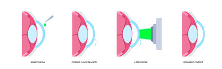 LASIK eye surgeryのイラスト素材