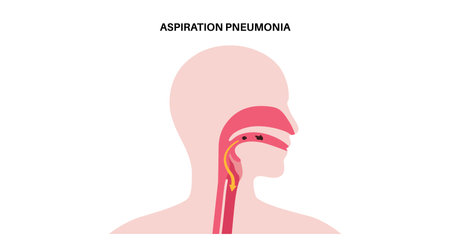 Aspiration pneumonia posterのイラスト素材