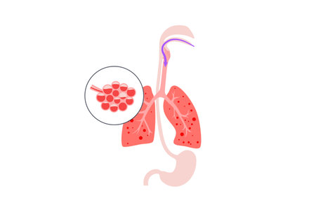 Aspiration pneumonia posterのイラスト素材