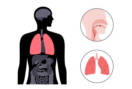 Aspiration pneumonia posterのイラスト素材