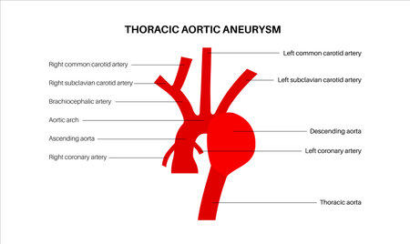 Thoracic aortic aneurysmのイラスト素材