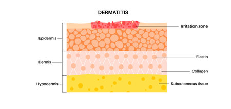 Dermatitis skin diseaseのイラスト素材