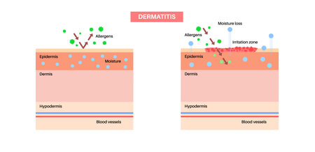 Dermatitis skin diseaseのイラスト素材