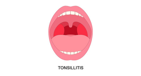Tonsillitis Oral Desease