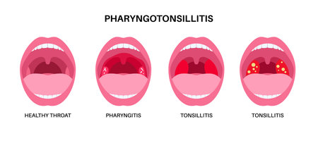 Pharyngotonsillitis oral disease