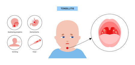 Tonsillitis Oral Deseaseのイラスト素材