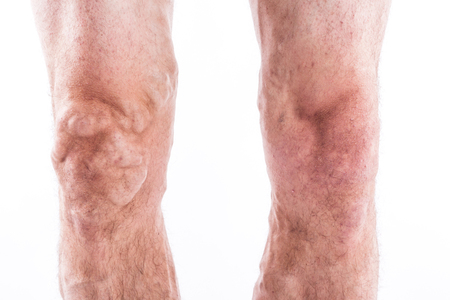 human leg with blocked veins, thrombosis, phlebitis, and standing on a white background, with depth of field Photoの写真素材
