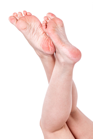female legs with overdried dehydrated dry skin on heels closeup, cracked and dry skin on heelsの写真素材