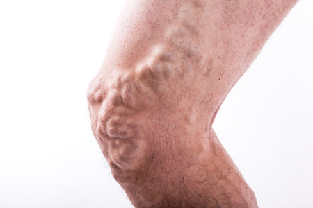 human leg with blocked veins, thrombosis, phlebitis, and standing on a white background, with depth of field Photoの写真素材