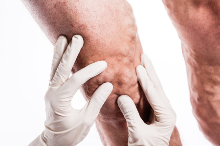 human leg with blocked veins, thrombosis, phlebitis, and standing on a white background, with depth of field Photoの写真素材