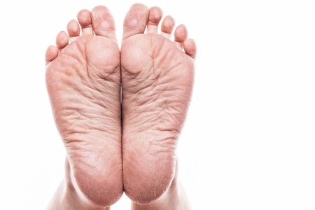 groomed dry skin on feet and heels, cracked cornの写真素材
