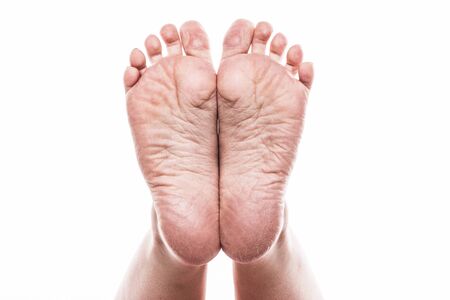 groomed dry skin on feet and heels, cracked cornの写真素材