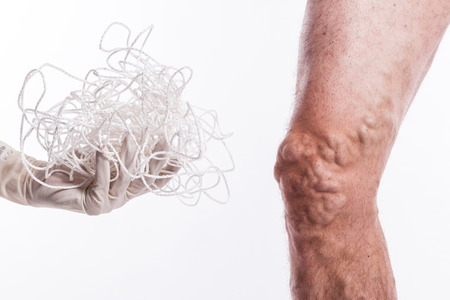 human leg with blocked veins, thrombosis, phlebitis, and standing on a white background, with depth of field Photoの写真素材