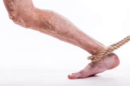 human leg with blocked veins, thrombosis, phlebitis, and standing on a white background, with depth of field Photoの写真素材