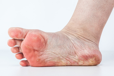 dehydrated skin on the heels of female feetの写真素材