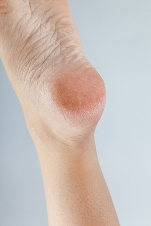 groomed dry skin on feet and heels, cracked cornの写真素材