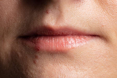 human lips close up with pimples on the faceの写真素材