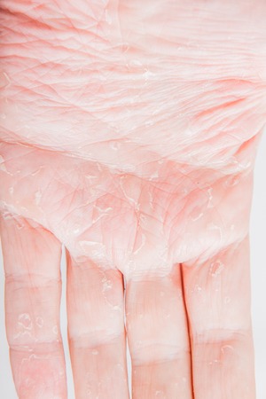 The problem with many people - eczema on hand. Isolated background.の写真素材