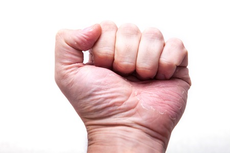 The problem with many people - eczema on hand. Isolated background.の写真素材