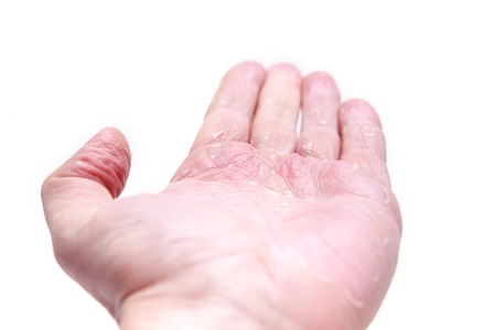 The problem with many people - eczema on hand. Isolated background.の写真素材