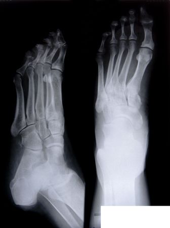 health medical image of an x ray of the feetの写真素材