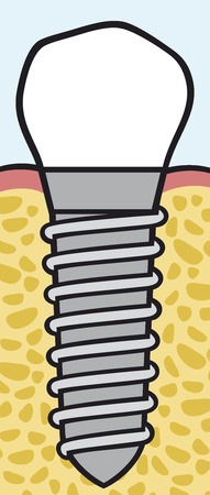 dental implantのイラスト素材