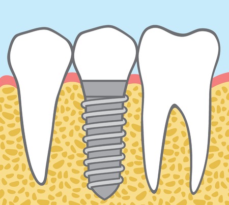 dental implantのイラスト素材