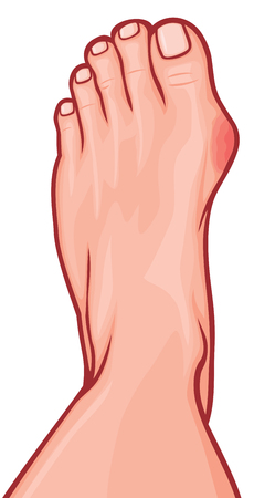 foot with a painful bunion foot deformity - bunion deformityのイラスト素材