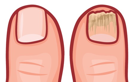 fungal infection of the nails vector illustrationのイラスト素材