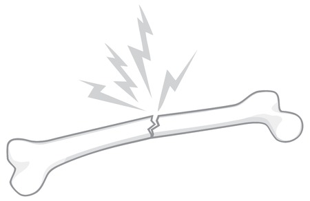 broken human bone vector illustrationのイラスト素材