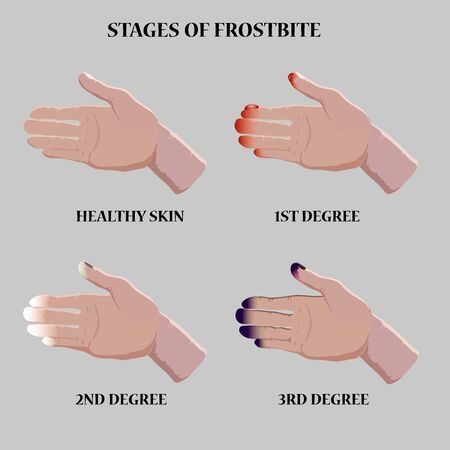 Medical vector illustration. Frostbite stages. Blue and red frostbitten fingers.  Stages of hypothermia in cold season. のイラスト素材