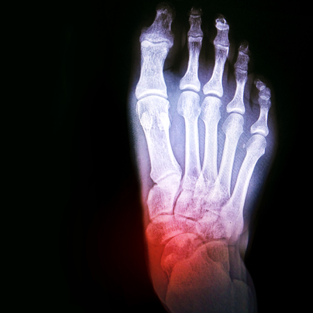 Dislocation of the ankle or arthritis of the joint. X-ray of the foot with the designation of the sore spot. Bone and joint health, conceptの写真素材