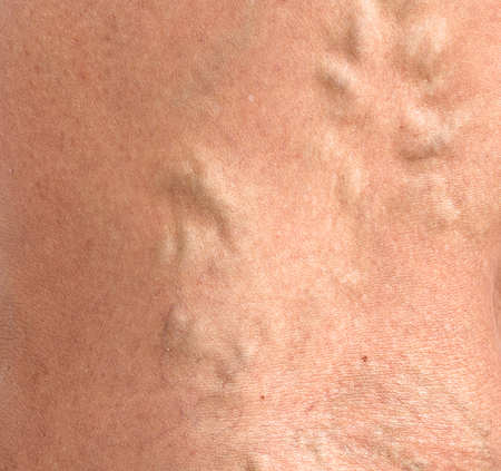varicose veins on the skin macro close up circulation problem medicine