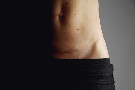 Closeup of woman belly with a scar from a cesarean section and heart healthの写真素材