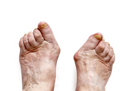 Closeup of a foot with damaged nails because of fungus. Elderly woman legs. Diabetisの写真素材