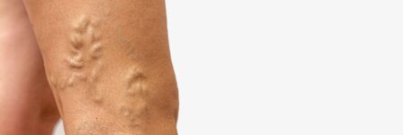 Legs pain concept - legs tied with rope isolated on white