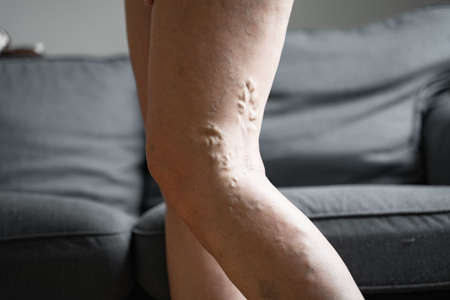 Varicose vein close up leg. Senior woman health problem. Foot with Diseased Veins. Health Care, Podiatry.の写真素材