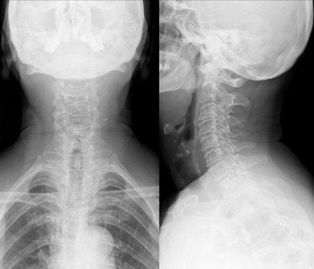 X-ray medical picture - Cervical spine and headの写真素材