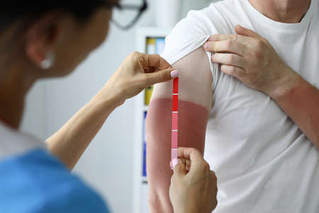 Healthcare professional determines degree of sunburn in patientの写真素材