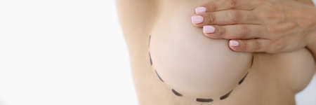 Markings are applied on female breast before plastic surgery mammoplastyの写真素材