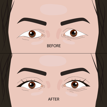 double eyelid surgery before and after vector illustration.のイラスト素材