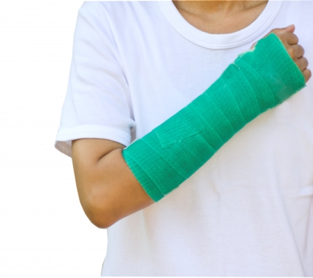 green cast on hand and arm の写真素材