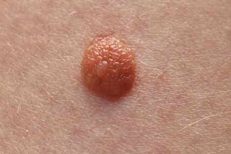 Irregular beauty mark showing changes on skin in melanoma patientsの写真素材