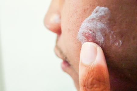 Acne on the face of the male adolescents.Selective focus