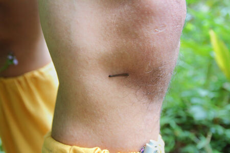 leech biting human knee in rainforest